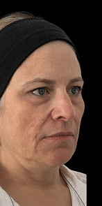 endolift_image_2_resized-768×768 1 endolift_image_2_resized-768x768 1