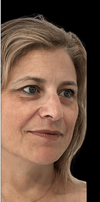 endolift_image_2_resized-768x768 2